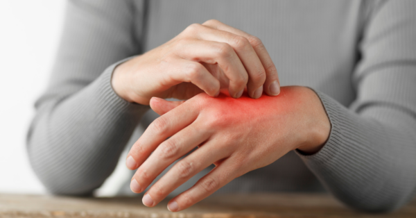 Occupational Skin Dermatitis Image